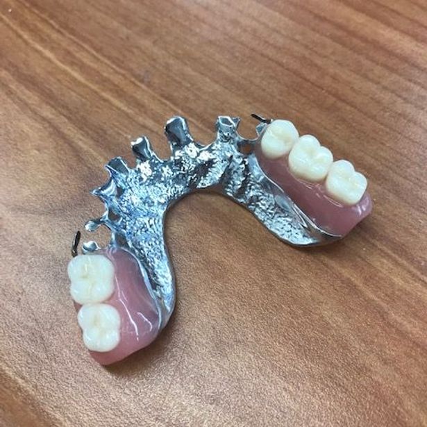 Newly done chrome partial denture