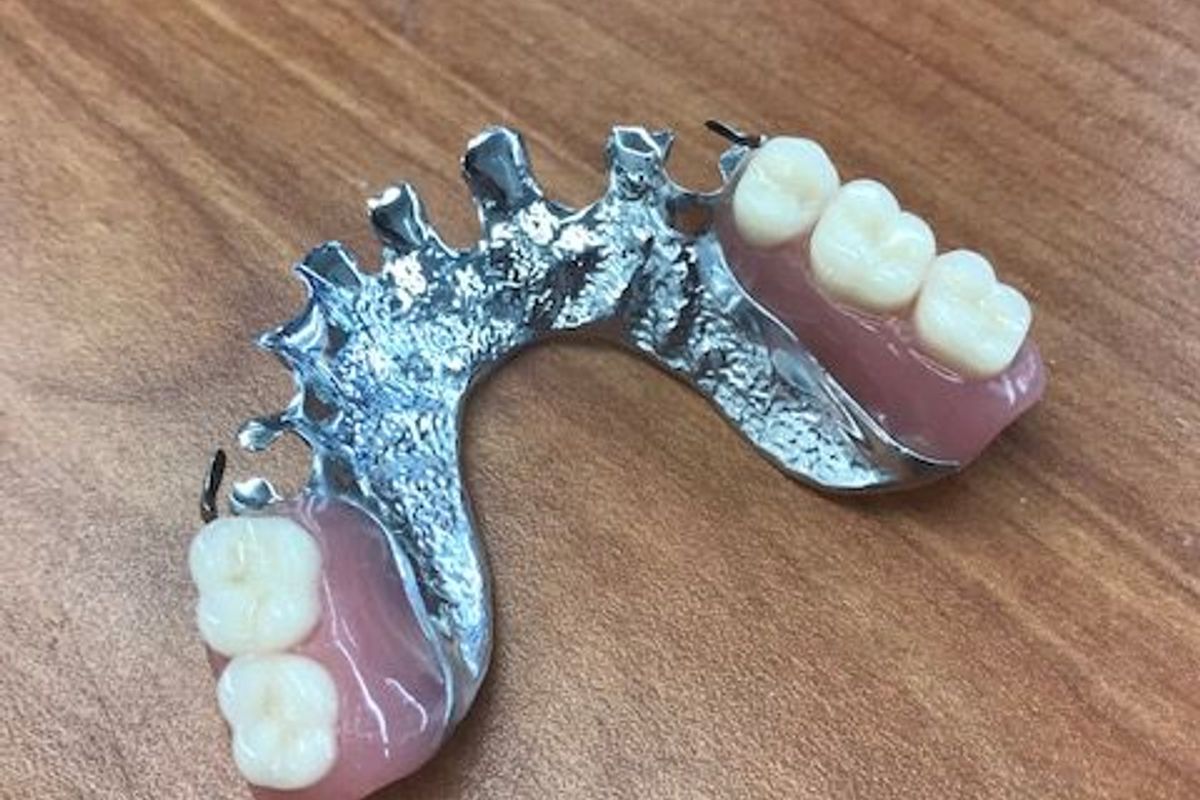 Chrome Partial Denture featured image